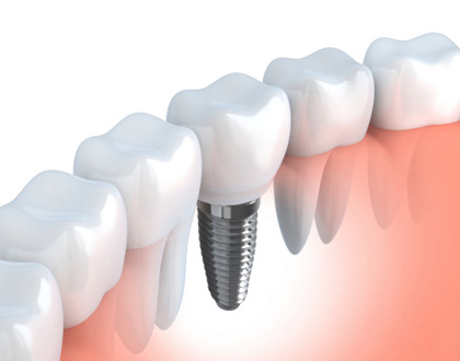 Dental implant