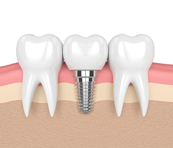 What are all on four dental implants - Scottsdale, AZ