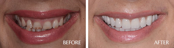 Before and After image of dental implant procedure in Scottsdale AZ Area